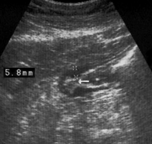  Gastric carcinomas of diffuse infiltrative form in the atrium of T2 stage. Compensated pyloric stenos. On an   empty stomach in the cavity of the     stomach is determined an a small amount of fluid. The diameter of the  pyloric canal more than 7 mm.
