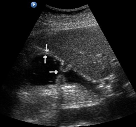  Ultrasonography of the stomach. The vertical arrows show the anterior wall of the antrum; the               horizontal arrows – pyloric, which is not fully open.