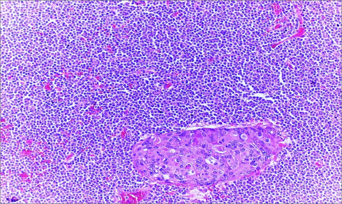  Adenocarcinoma with MALT lymphoma infiltration of lymph node (h&e;200)