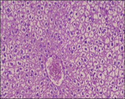  Photomicrograph of liver section of obese rat showing swollen hepatocytes with vacuolated cytoplasm filled  with fatty  infiltration, congested central vein  and disappearance of blood sinusoids, (H&E) (40X).
