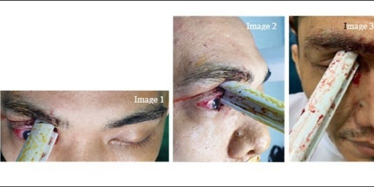 Journal of Ophthalmic Science-Orbitocranial penetrating injury